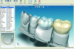 Протезирование CAD/CAM