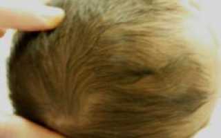 Что такое родничок у новорожденного и когда он зарастает
