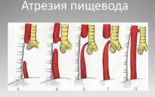 Атрезия пищевода у новорожденных